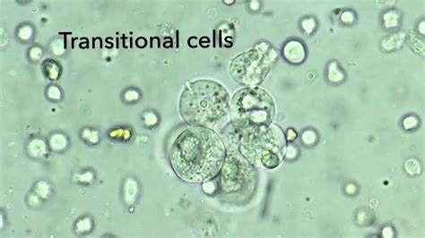 Transitional Epithelial Cells In Urine Youtube