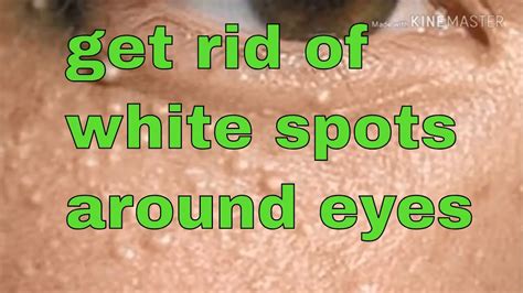 How To Get Rid Of White Spots Around Your Eyes How To Get Rid Of