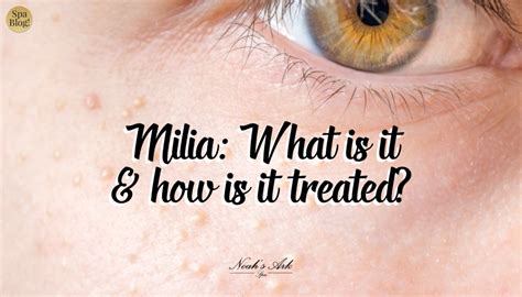 Milia What Is It What Causes It And How Is It Treated