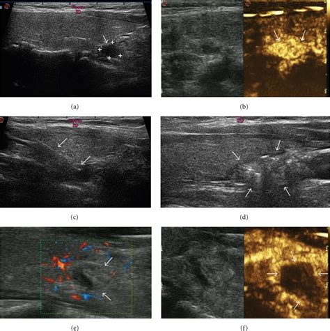 Figure 1 From Percutaneous Ultrasound Guided Laser Ablation With