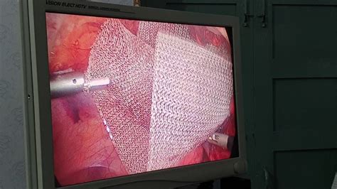 Mesh Placement In Tapp For Left Inguinal Hernia Youtube