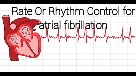 Rate And Rhythm Control Strategy For Atrial Fibrilation Youtube