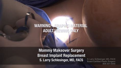 Breast Implant Exchange Using A Transaxillary Incision Gummy Bear