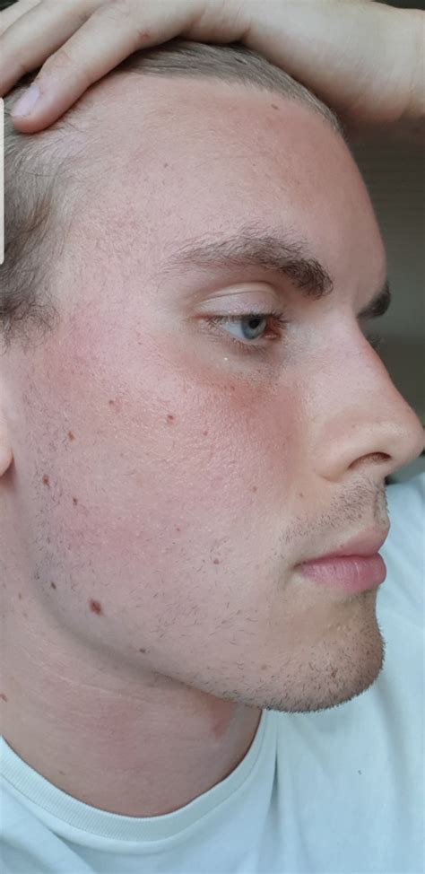 Still Extremely Drydehydrated Skin 15 Year Post Accutane Help R