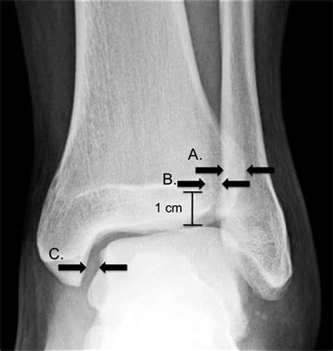 Injuries To The Ankle Syndesmosis Jbjsam Ankle Injury