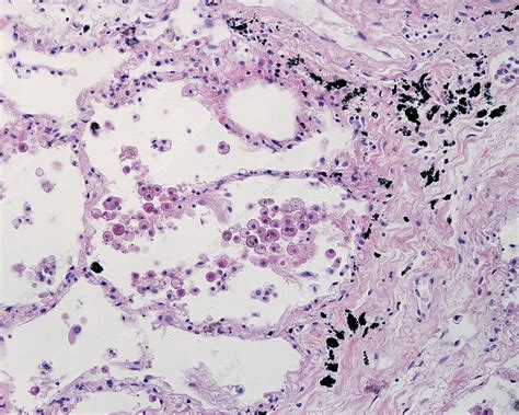 Alveolar Macrophages Light Micrograph Stock Image C0386276