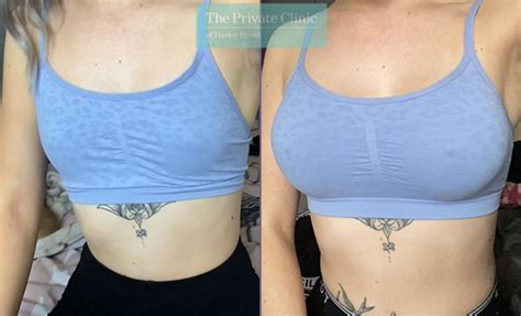 Breast Augmentation 23 Years Old Chloe Boob Job Experience Breast