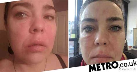 Mum Whose Confidence Was Ruined By Mystery Skin Rash Is ‘saved By £49