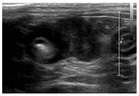 Ultrasonographic Image Cat 4 Transverse Sonogram Of A Thickened
