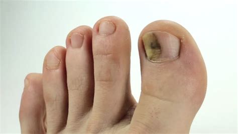 Most common in people with dark skin, toenail melanoma can affect any nail on the foot. Toe Nail Fungus: Causes, Symptoms and Home Remedies ...
