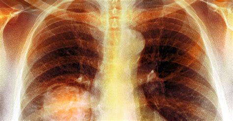 Cuba Quietly Developed A Lung Cancer Vaccine That America Desperately Wants