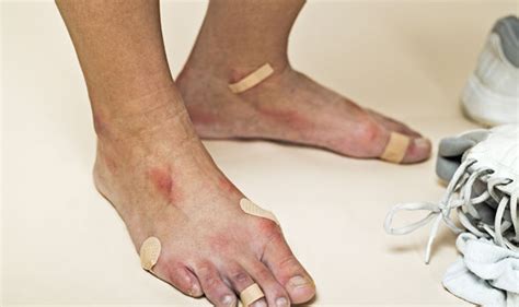Should You Pop A Blister How Do You Know If A Blister Is Infected