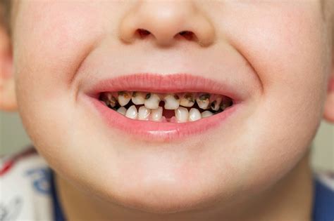 Le Syndrome Du Biberon Comment Traiter Les Caries Des Dents De Lait Information