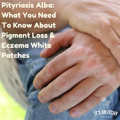 Pityriasis Alba What You Need To Know About Pigment Loss And Eczema
