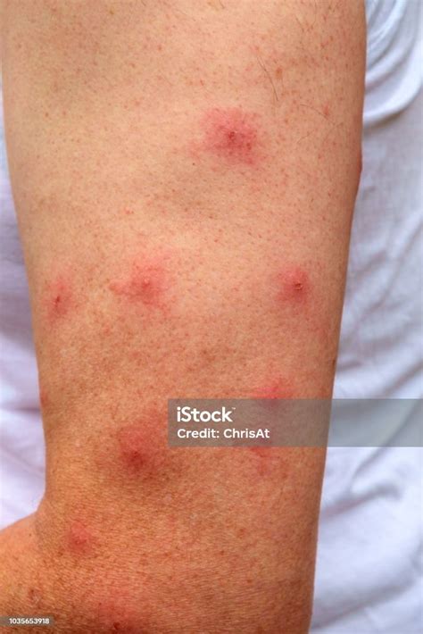 Insect Bite Allergy Ph