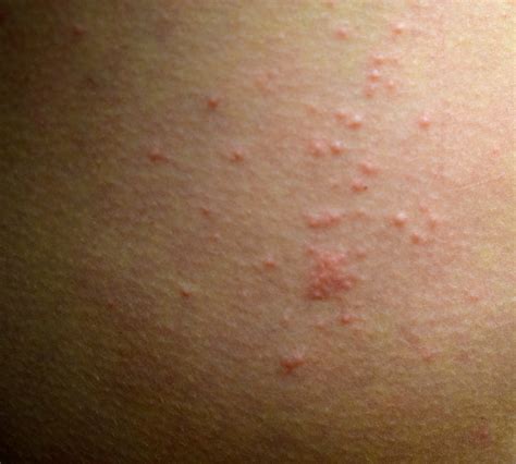 Can You Get Scabies From A Hotel Room Bed Bed Western