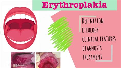 Erythroplakia Precancerous Lesion Cause I Clinical Features I