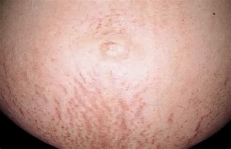 Red Rash On Belly Pregnant Pregnantbelly