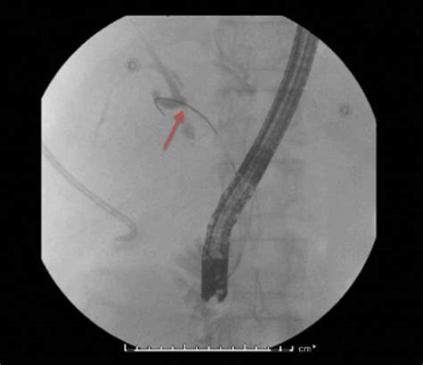 Fluoroscopy Image During Endoscopic Retrograde Cholangiopancreatography