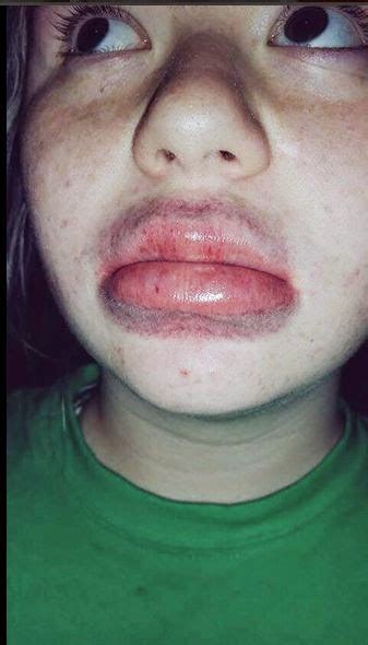 the kylie jenner lip challenge ethos medical spa nj