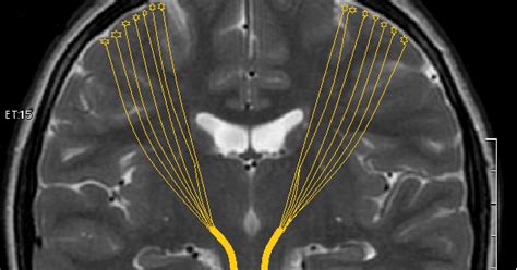 Amyotrophic lateral sclerosis (als) is the most common degenerative disease of the motor neuron system. El Baúl Radiológico: ESCLEROSIS LATERAL AMIOTRÓFICA. HALLAZGOS EN TOMOGRAFÍA POR RESONANCIA ...