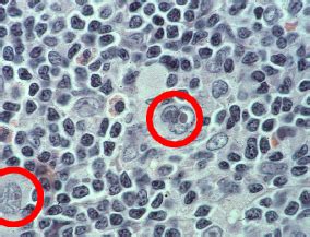 Despite progress in basic research showing the natural precursor cells of hodgkin's lymphoma, most key questions still. Definition und Ätiologie - GHSG - German Hodgkin Study Group