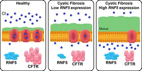 Modifier Gene May Explain Why Some With Cystic Fibrosis Are Less Prone