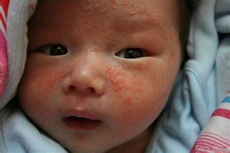 轻微婴儿湿疹的图片有来医生