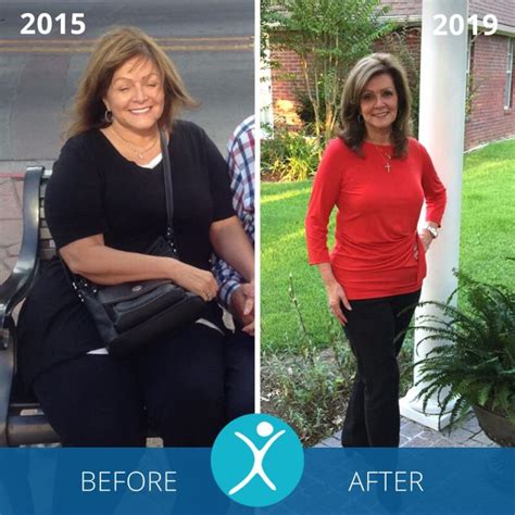 Gastric Sleeve Before And After Photos The Best Pictures Of