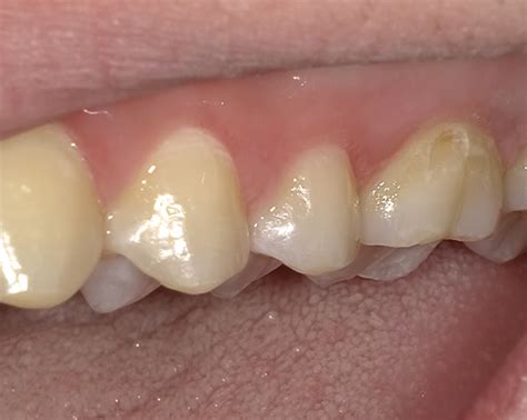 White Spot Lesions On Molars