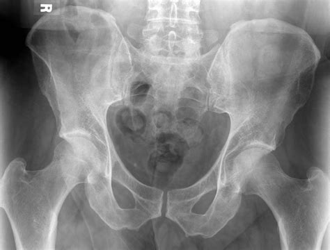 X Ray Of Normal Pelvis Male Eccles Health Sciences Library J
