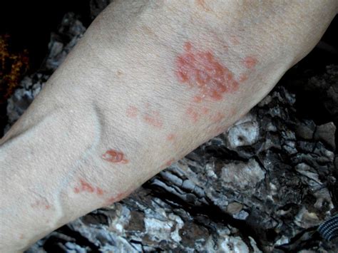 How To Identify 9 Common Skin Rashes Shingles Rash Skin Rashes Images