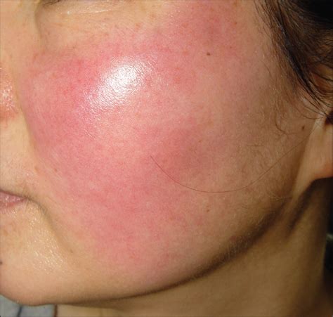 carvedilol for the treatment of refractory facial flushing and persistent erythema of rosacea