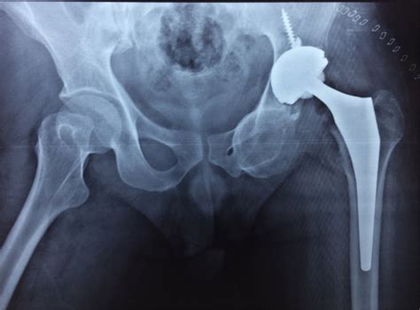 Immediate Post Operative Radiograph Of Pelvis With Both Hips In