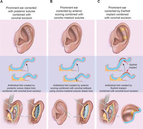 Earfold A New Technique For Correction Of The Shape Of The Antihelix