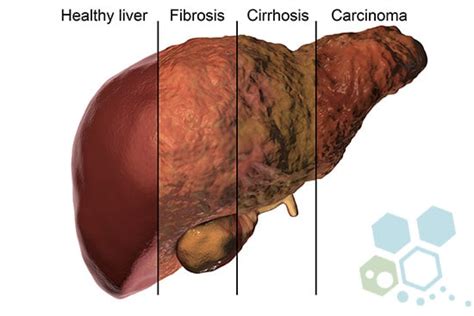 Car T Therapy And Stem Cells For Liver Cancer