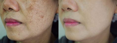 Different Types Of Skin Blemishes And Its Treatments Get Blemish Free