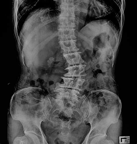 Adult Degenerative Scoliosis Chibuikem Akamnonu Md