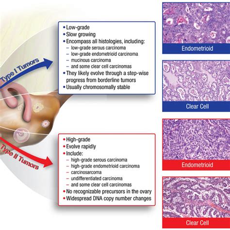 Early Tumor Progression Within The Fallopian Tube And The Resultant