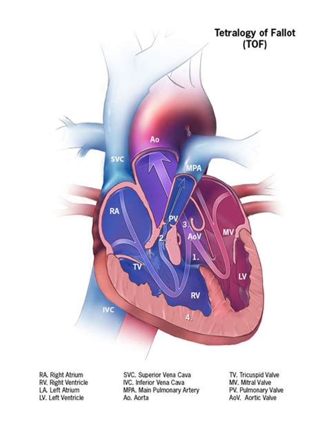 Facts About Tetralogy Of Fallot Congenital Heart Defects Ncbddd Cdc