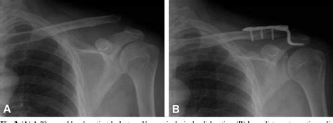 Figure 2 From The Necessity Of Coracoclavicular Ligament Repair In Open