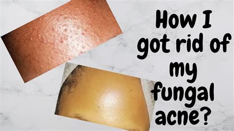 How I Got Rid Of My Fungal Acne Treatment Tips Dos And Donts South