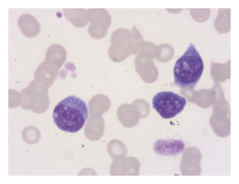 A Bm Aspirates Suggesting Plasma Cell Proliferation Wrights Stain
