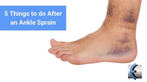 Top 5 Fridays 5 Things To Do After An Ankle Sprain Eva Porter Blog