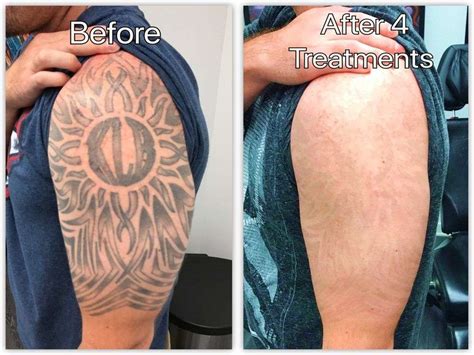 Chirurgie de détatouage avant et après TattooTalk net