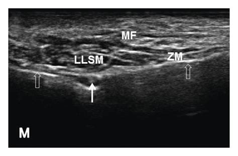 Sonoanatomy And Ultrasound Guided Injection Technique For The