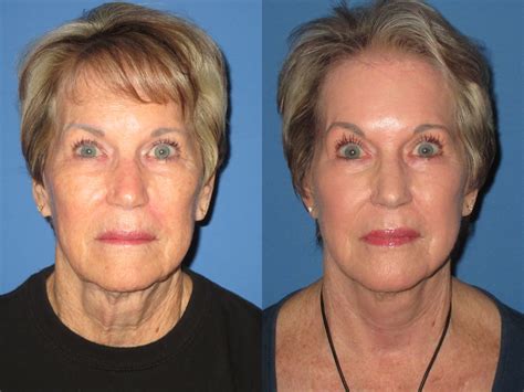 Facelift Before And After Photos Elite Facial Plastic Surgery