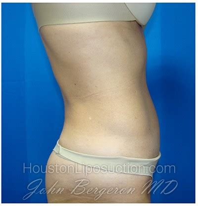 Patient Liposuction Before And After Photos Katy Cosmetic