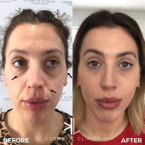 Tear Trough Fillers Treating Tired Looking Eyes Kl Cosmetics Clinic
