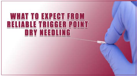 What To Expect From Reliable Trigger Point Dry Needling Expert Guide